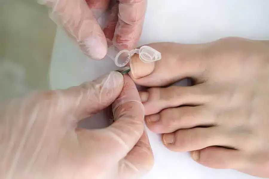 Podolog Poznań - grzybica paznokci leczenie